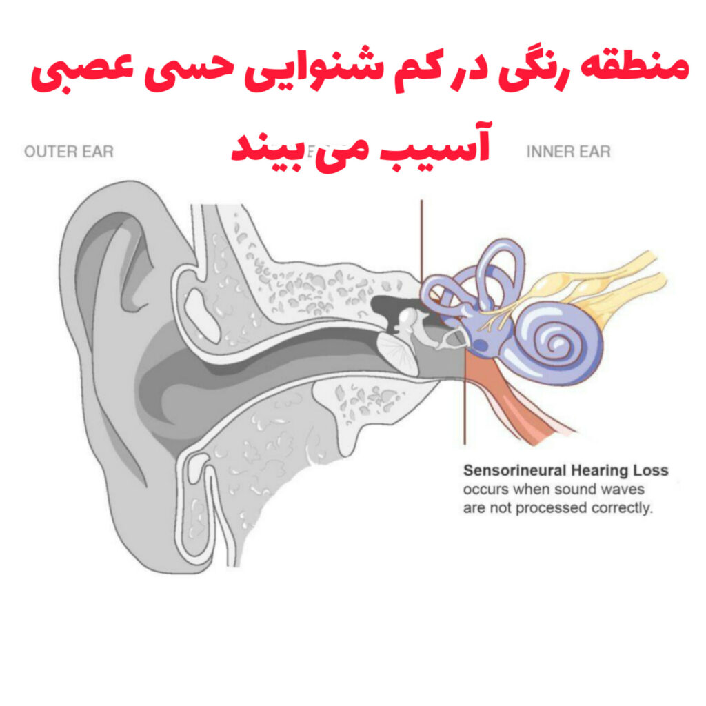 آیا کم شنوایی حسی عصبی درمان دارد؟