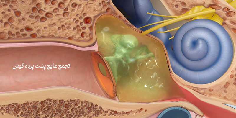 درمان خانگی جمع شدن مایع پشت گوش