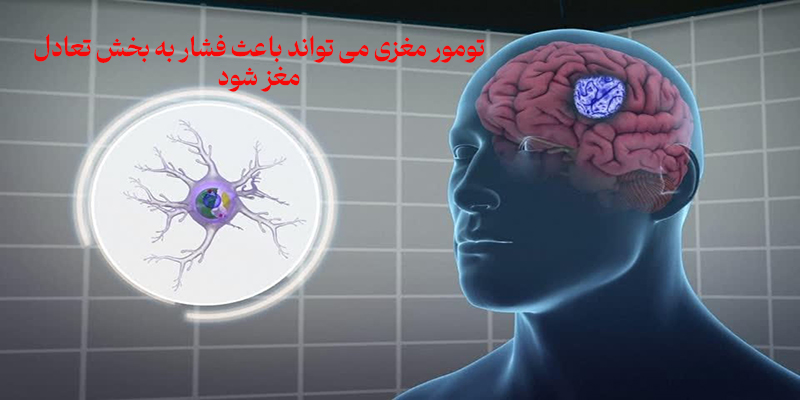 ارتباط تومور مغزی و سرگیجه